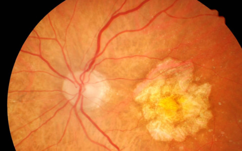 Chiusura della Settimana Mondiale della Vista