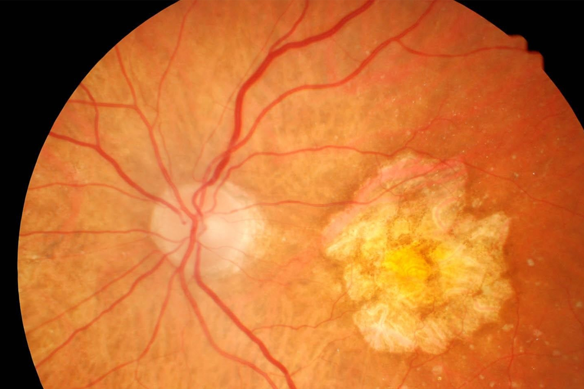 Chiusura della Settimana Mondiale della Vista